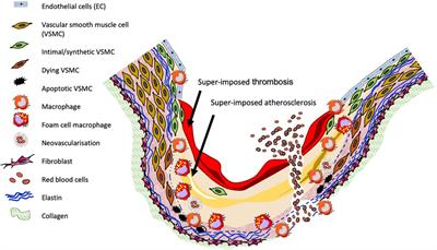 The contribution of matrix metalloproteinases and their inhibitors to the development, progression, and rupture of abdominal aortic aneurysms